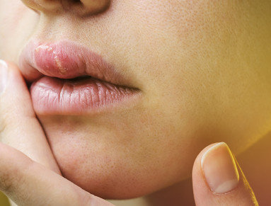 herpes prejuges
