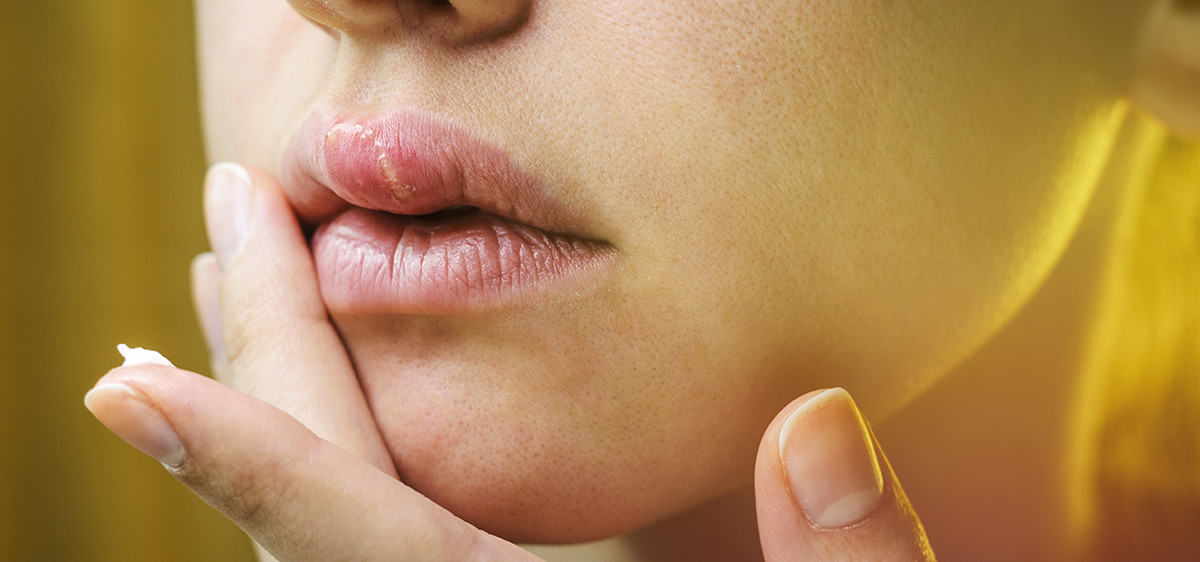 herpes prejuges
