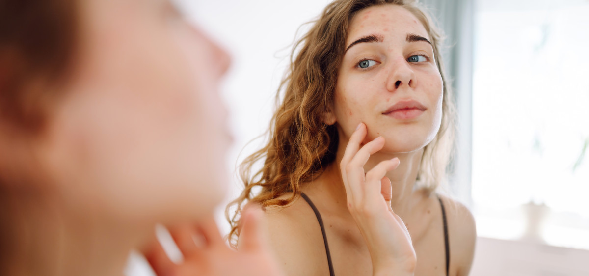 femme acné peau atopique