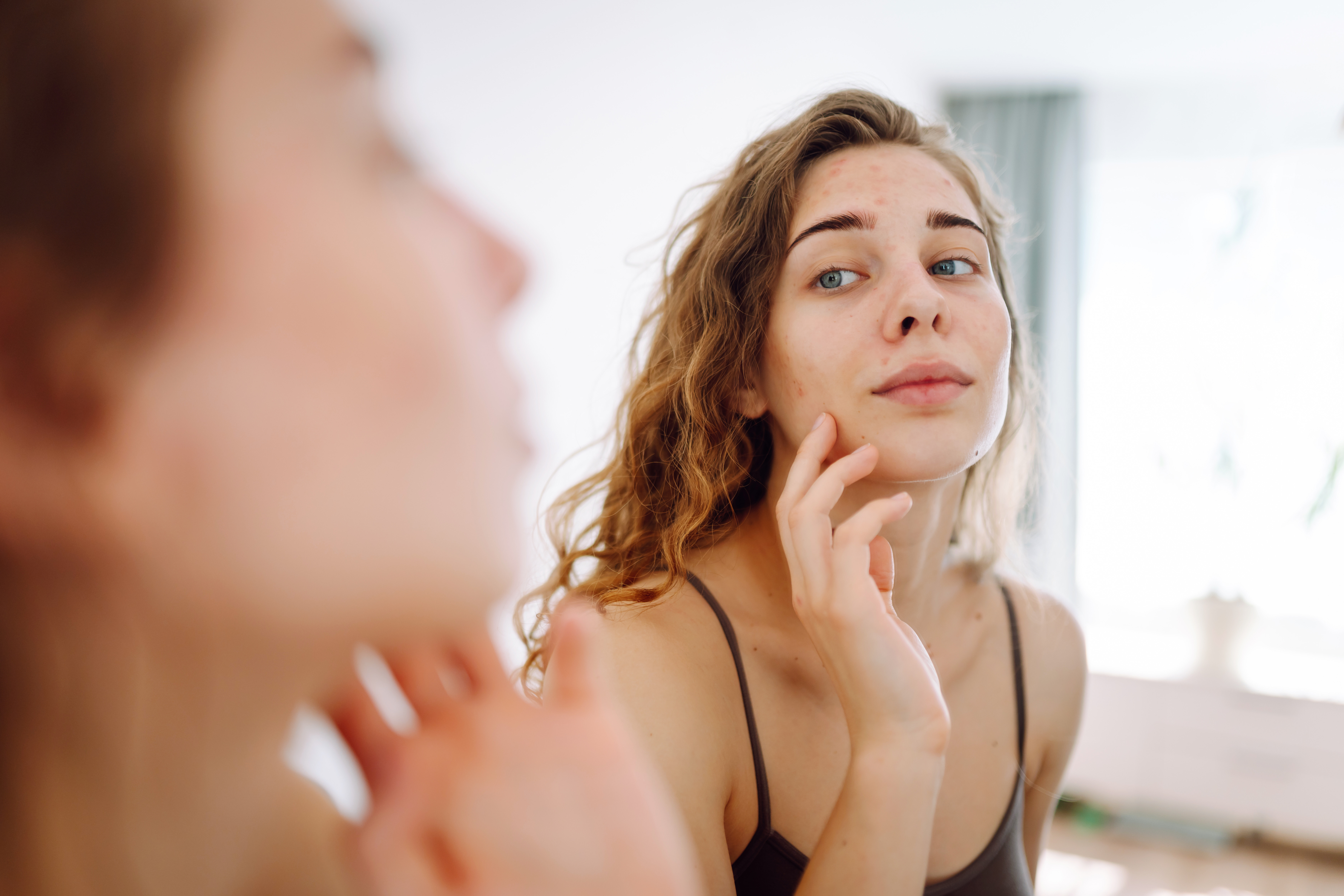 Peaux atopiques : vrai/faux sur les idées reçues 